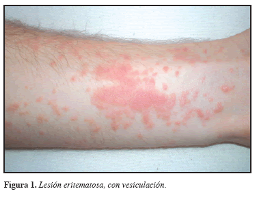 Cómo Provoca Irritación En La Piel El árbol Manzanillo?